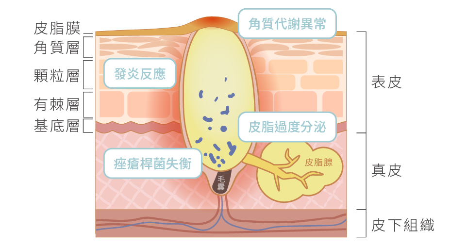 痘痘肌的原因與保養方式